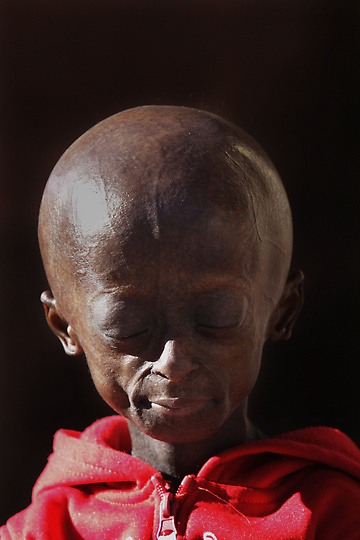 South Africa Progeria Girl