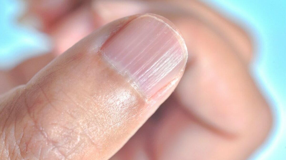5 распространенных дефектов ногтевой пластины, которые часто ошибочно принимают за косметические работе, ногти, дефицит, только, ногтевой, сразу, нарушения, стоит, ногтях, такие, время, может, органов, показатель, пальцах, повреждения, ногте, органы, борозды, таких