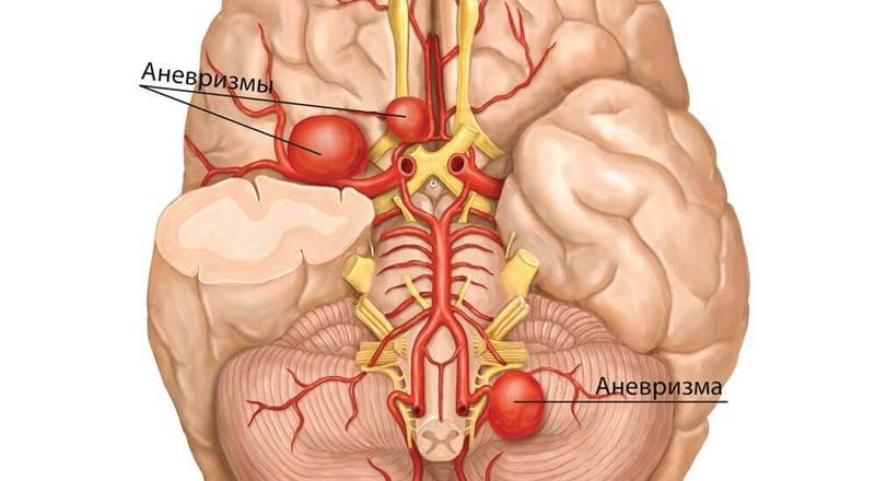 Чем опасна аневризма и кому она грозит  здоровье, кровь, питание, сердце, сосуды,тромб
