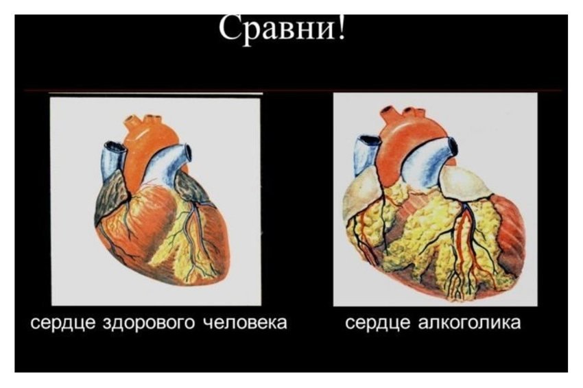Сердечный попить. Сердце здорового человека и сердце алкоголика. Сердце пьющего человека.