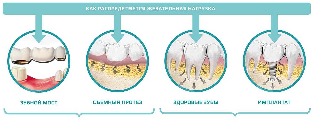 Какие есть недостатки у съемных протезов?