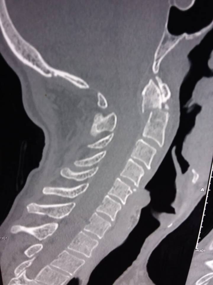 Перелом шеи. Зубовидный отросток на рентгенограмме. Переломы шейного отдела позвоночника травматология. Смертельный перелом шейных позвонков.