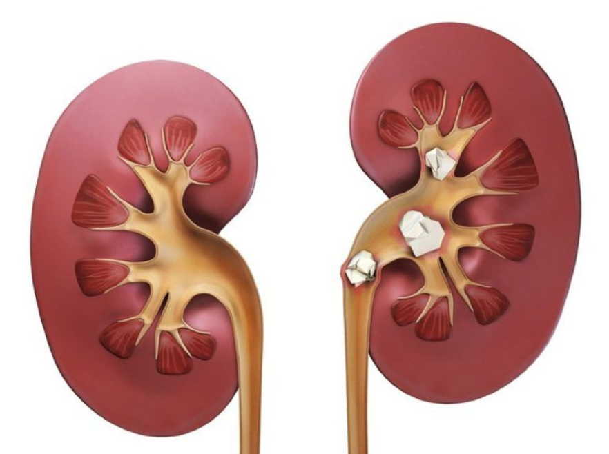 Три способа очистки почек от камней - сейчас самое время!