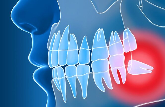 Зачем нам зубы мудрости и нужно ли их удалять? медицина,стоматология