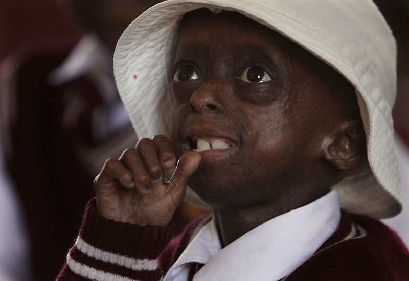 South Africa Progeria Girl