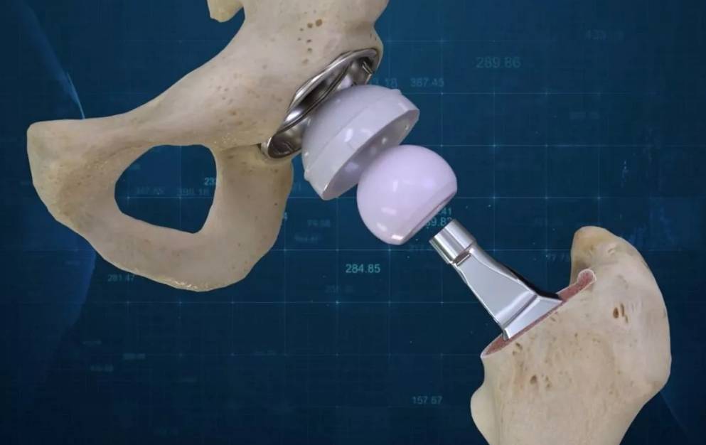 Синовиальные протезы отзывы. Smith nephew эндопротез коленного сустава. Эндопротез k-Implant. Имплантат тазобедренного сустава. Протез тазобедренного сустава Zimmer.