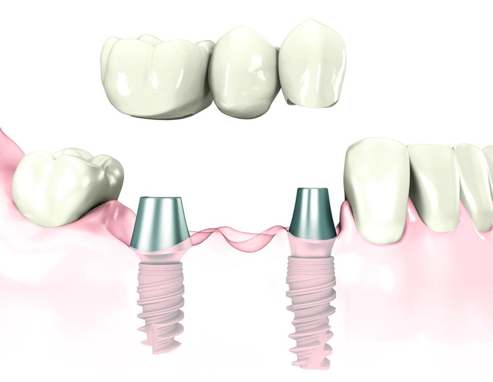 Как выбрать идеальные зубные протезы