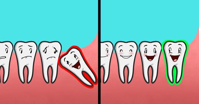 Зачем нам зубы мудрости и нужно ли их удалять? мудрости, зубов, людей, появляются, приводит, удалять, растут, когда, часто, взрослых, проблемы, в возрасте, мудростиЗубы, имеют, с зубами, потом, удаления, почему, проблем, поэтому