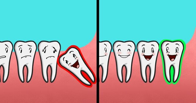 Зачем нам зубы мудрости и нужно ли их удалять? медицина,стоматология