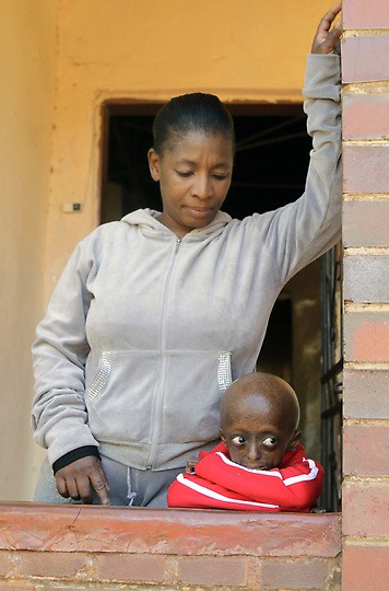 South Africa Progeria Girl