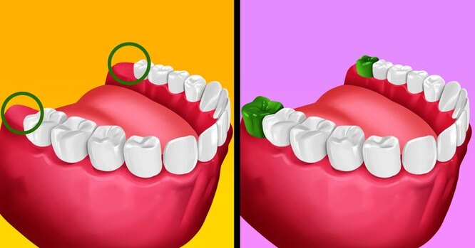 Зачем нам зубы мудрости и нужно ли их удалять? медицина,стоматология