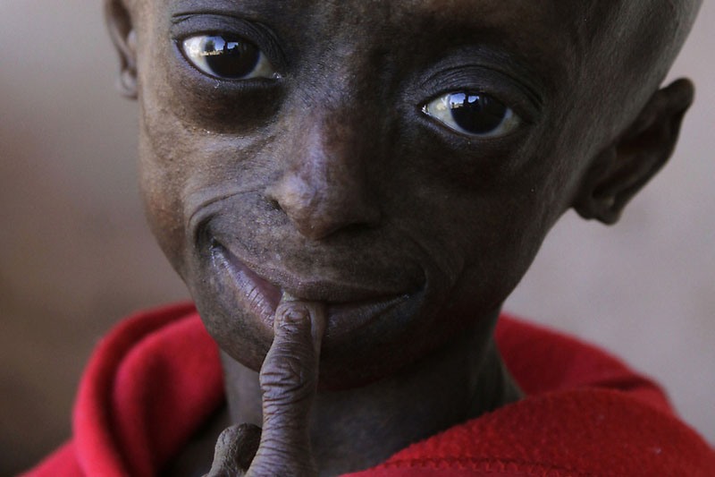 South Africa Progeria Girl