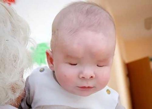 8-Месячному ребенку из Томска, родившемуся без глаз, нашли приемную семью.