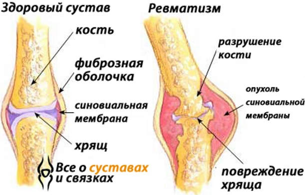 12 эффективных рецептов от суставного ревматизма. Жить без боли и страданий - запросто!