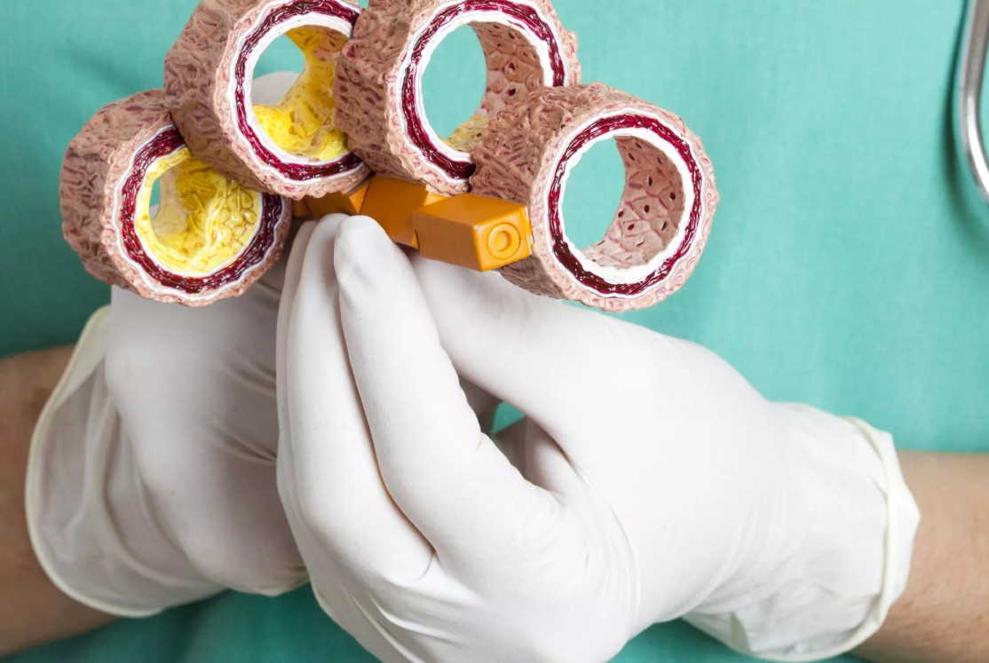 Склерозы: 5 ценных рецепта лечения!