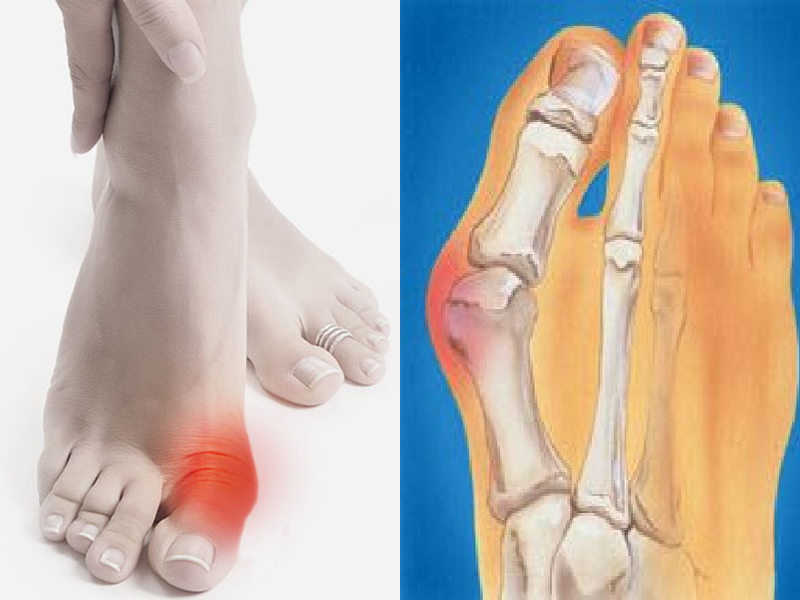 Баланс стопы: сильная остеопатическая техника от косточек на ногах здоровье,упражнения
