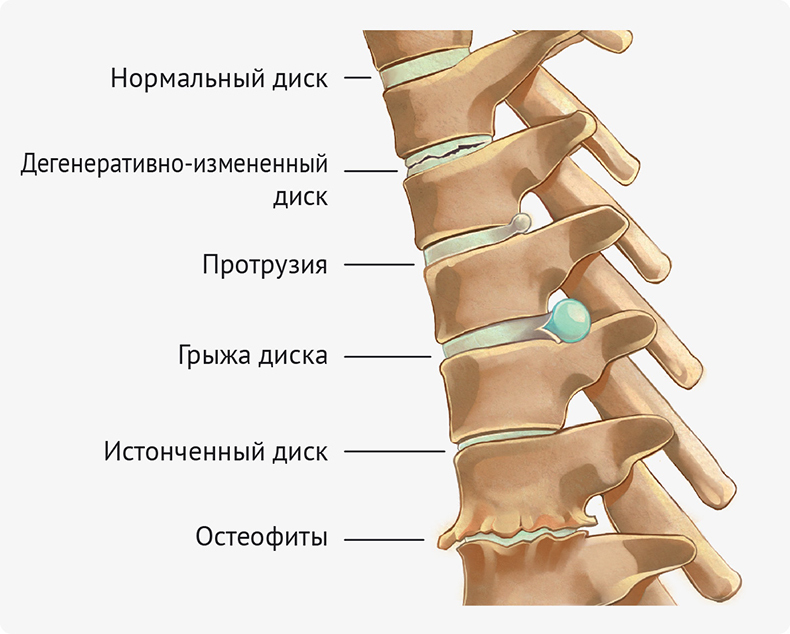 Грудной радикулит: Что можно, а чего нельзя  лечение, нагрузка, осанка, остеохондроз,парк,Здоровье [96577750], позвоночник, причины, спина, упражнения