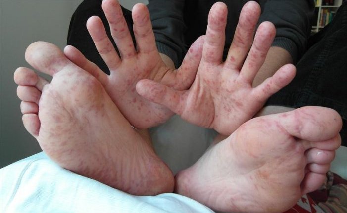 Coxsackievirusor_69643_701x526
