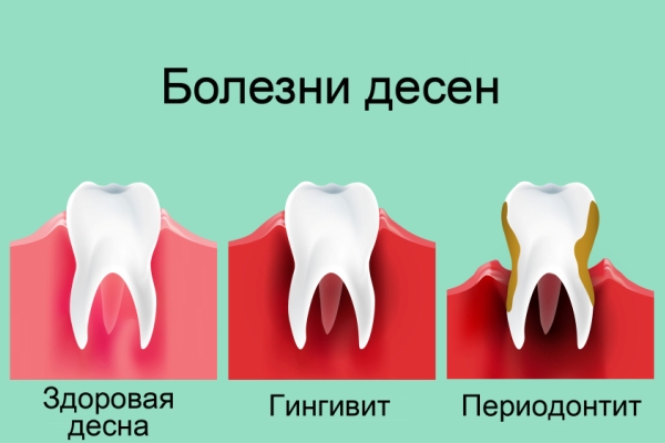 Картинки по запросу лечение воспаленных десен