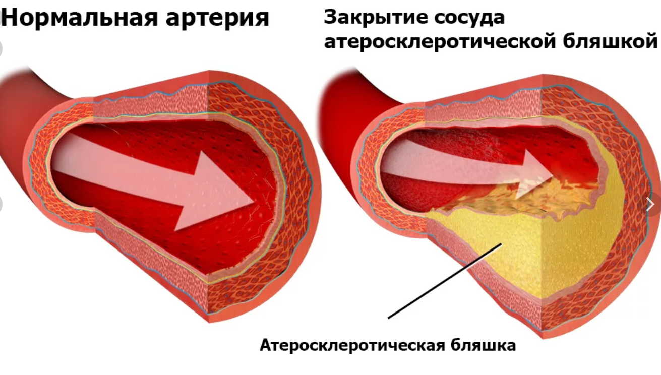 Склерозы: 5 ценных рецепта лечения!
