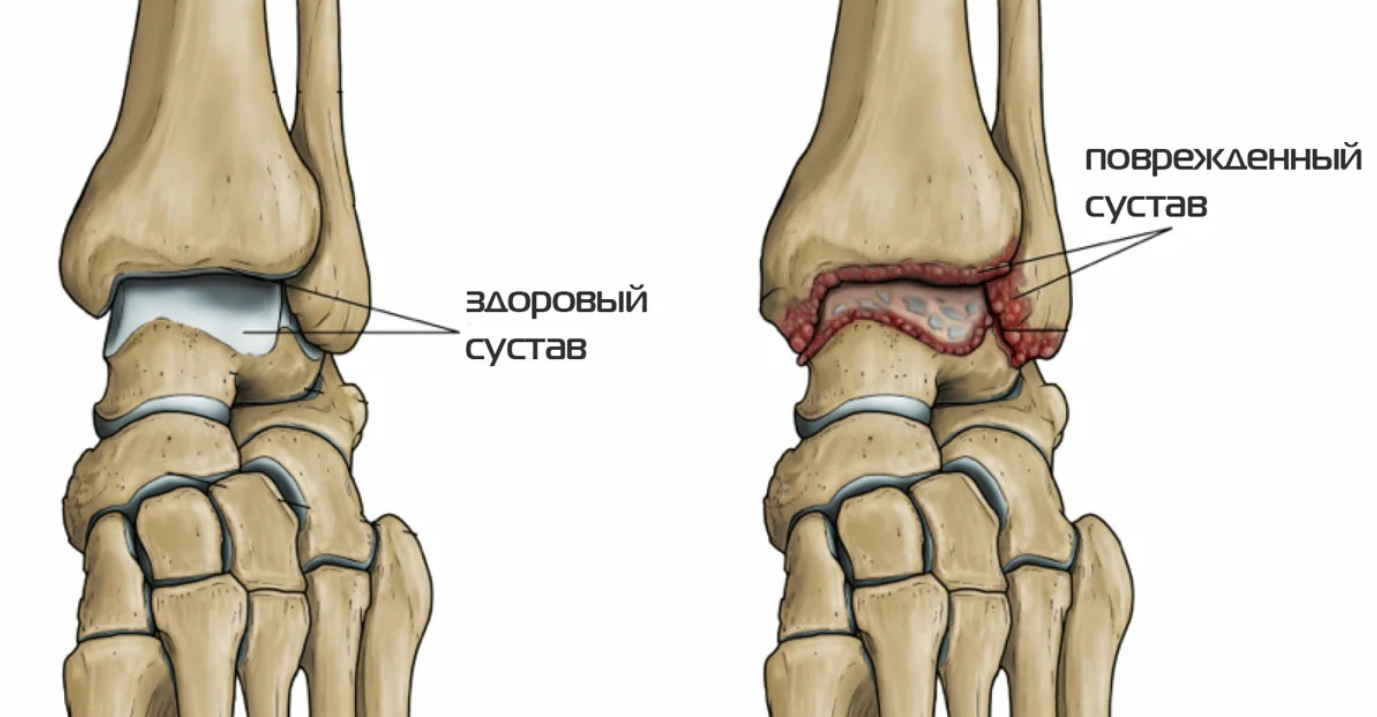 Удивительная мазь от артроза, подагры и радикулита