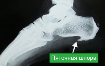 Основные причины появления боли в пятке при ходьбе пятке, пяточной, пятки, заболевания, только, сопровождается, пятку, заболевание, нестероидных, уменьшения, шпоры, жгучая, обозначают, термином, недуга, становится, ткани, фасции, стопе, сведению