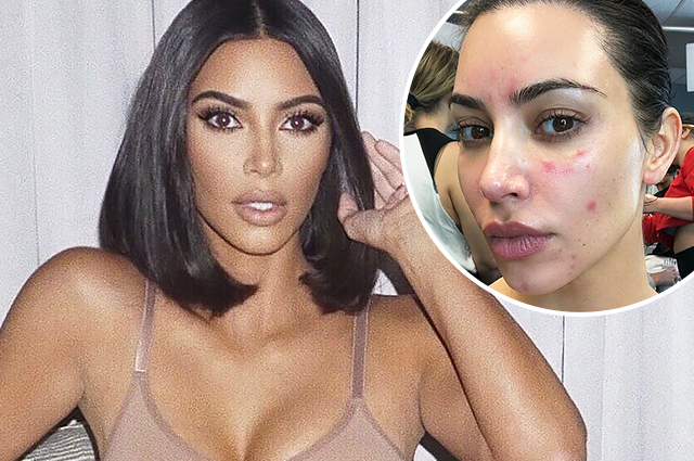 Ким Кардашьян о своей борьбе с псориазом: "В этом году все стало еще хуже"