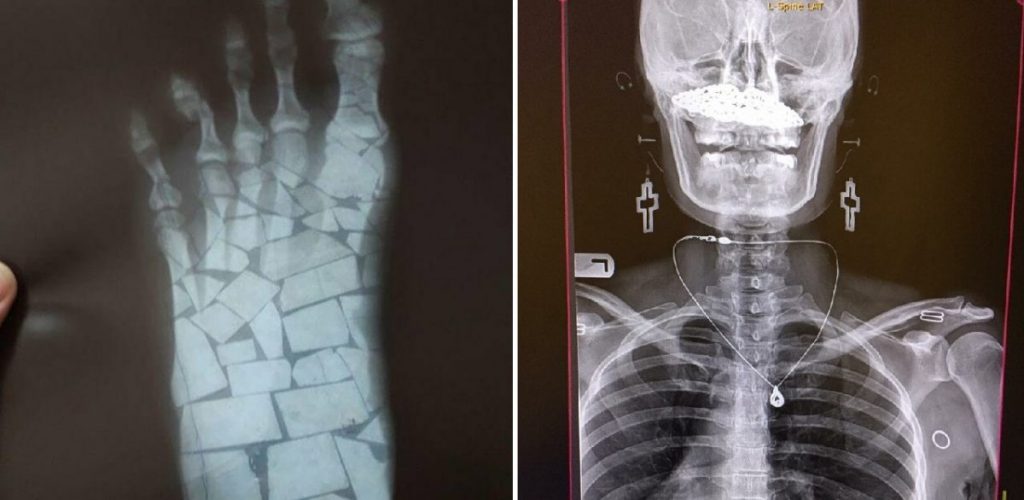 Богатый внутренний мир — 17 рентгеновских снимков, которые врачи не сразу развидят - свежие новости на Toplenta по теме Рентген