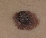 Какими бывают родинки: их типы и виды болезни