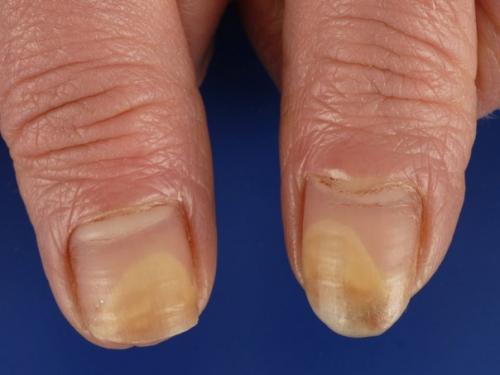 Грибок ногтей или онихомикоз: народные способы лечения.