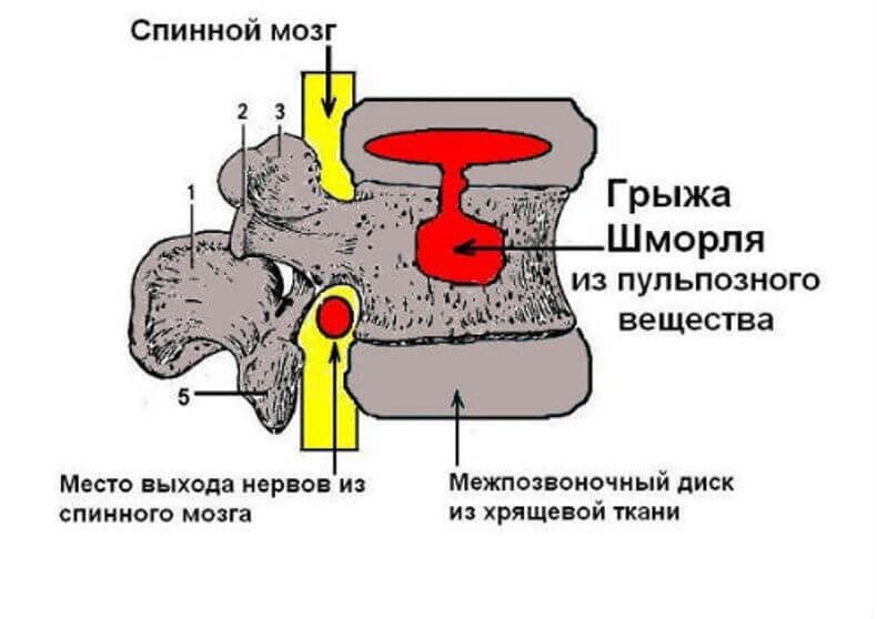 Грыжа шморля поясничного отдела. Единичная грыжа Шморля l2. Грыжа Шморля поясничного отдела позвоночника что это. Грыжа Шморля позвонков l1-s1.