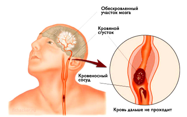 ИНСУЛЬТ: Запомните всего 3 первых шага, чтобы спасти себе и близким жизнь