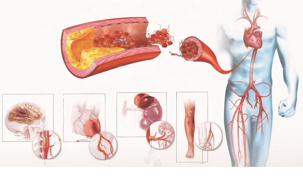 Картинки по запросу atherosclerosis and the artery