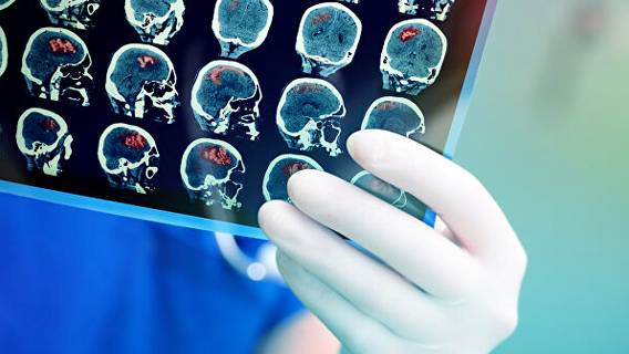 В США будут начаты клинические испытания китайского препарата от болезни Альцгеймера