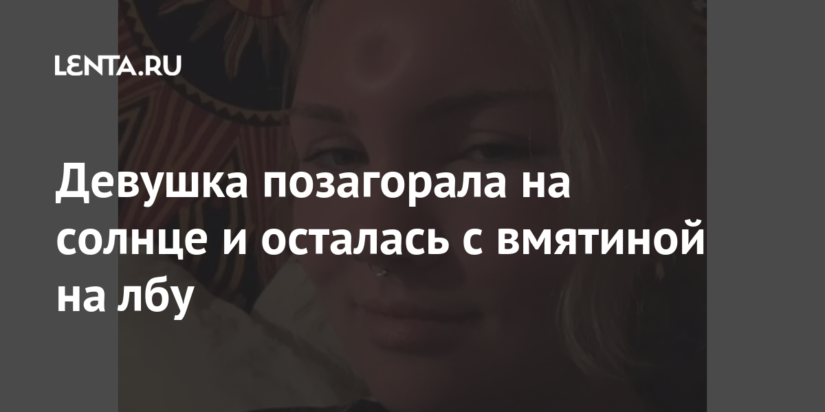 Девушка позагорала на солнце и осталась с вмятиной на лбу Ценности