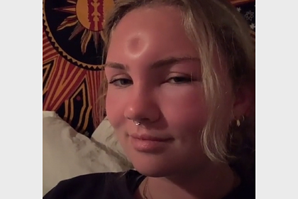 Девушка позагорала на солнце и осталась с вмятиной на лбу