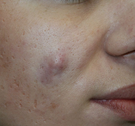 Какими бывают родинки: их типы и виды болезни