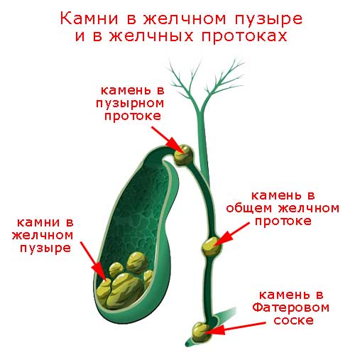 желчные камни в пузыре и в протоках