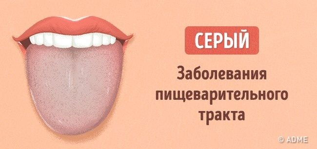 Что расскажет цвет языка о вашем здоровье