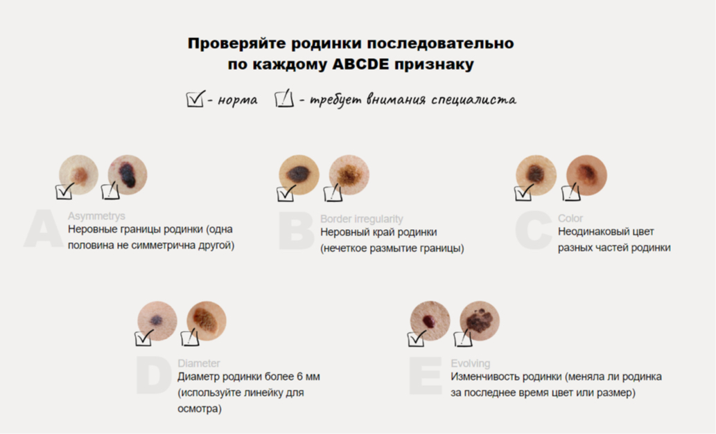 5 ответов на важные вопросы о родинках на нашем теле родинки, родинок, более, невусов, меланомы, количество, Титов, может, невусы, развития, Поэтому, проходить, спонтанно, опасные, могут, удалять, можно, риска, возникает, других