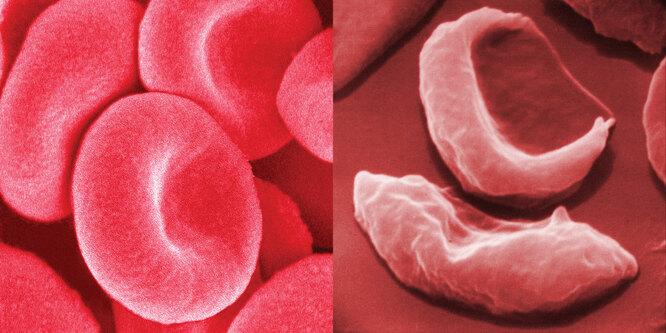 Слева — здоровые эритроциты; справа — кровяные тельца страдающих от серповидноклеточной анемии