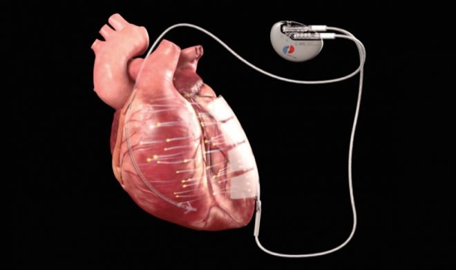 Новый имплант запускает регенерацию сердечной ткани электрическими импульсами гаджеты,имплант,технологии