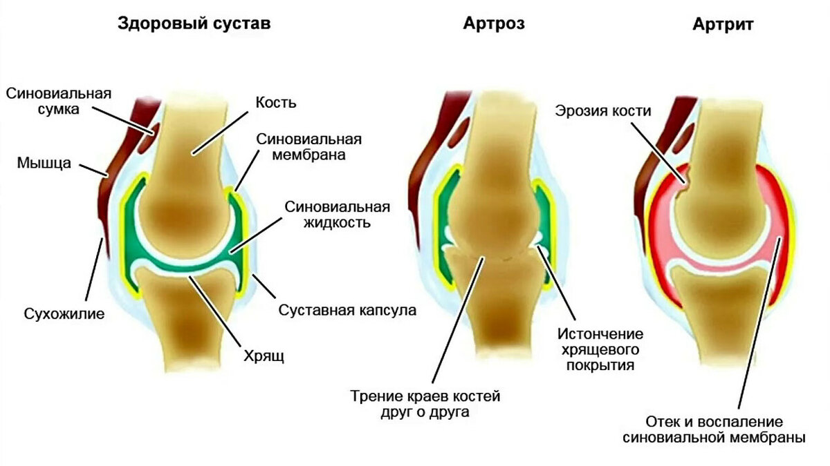 Почему артрит не перепутаешь с артрозом: причины появления этих заболеваний и как отличить их по ощущениям может, результате, могут, артрозе, развивается, заболевание, артрита, возникает, совсем, отличие, сопровождается, начаться, указывает, болезнь, является, воспалительным, которого, системы, состояние, суставной