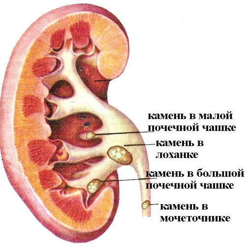 Мочекаменная болезнь — когда требуется госпитализация? здоровье,медицина,мочекаменная болезнь