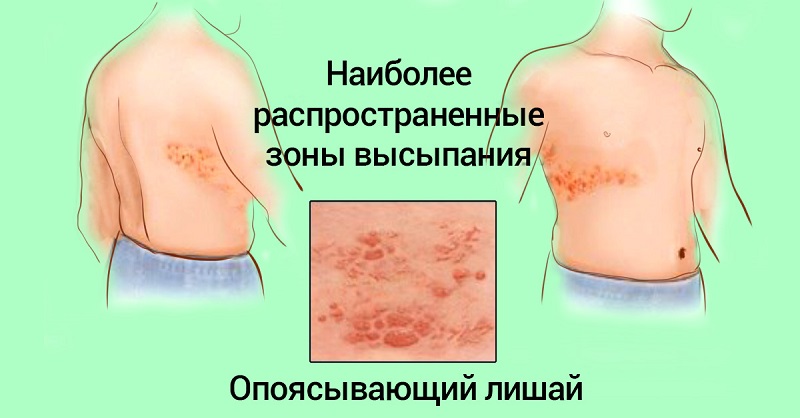 опоясывающий лишай лечение