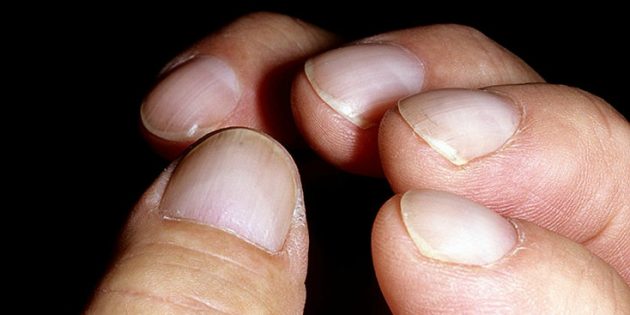 Посмотрите на свои ногти. Эти 12 отклонений могут многое рассказать о вашем здоровье болезни,здоровье,ногти