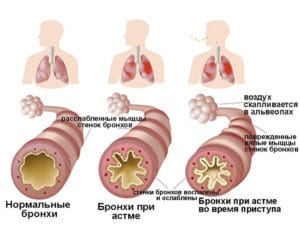 здоровые бронхи, бронхи при астме, бронхи при приступе астмы