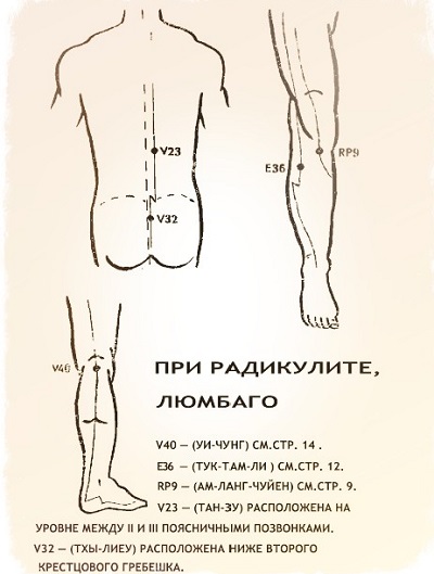 радикулит