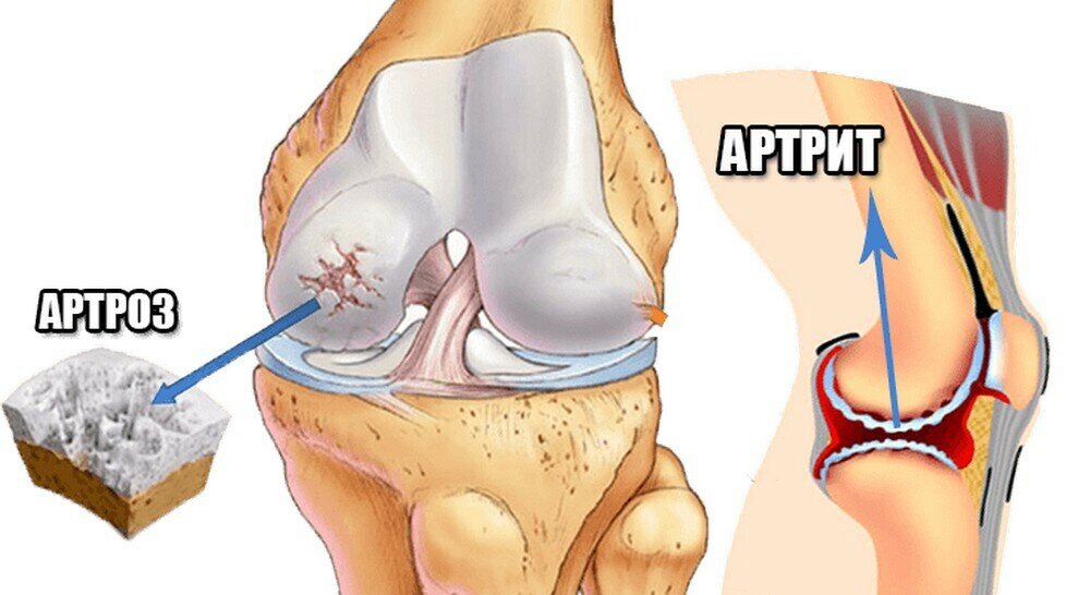 Почему артрит не перепутаешь с артрозом: причины появления этих заболеваний и как отличить их по ощущениям может, результате, могут, артрозе, развивается, заболевание, артрита, возникает, совсем, отличие, сопровождается, начаться, указывает, болезнь, является, воспалительным, которого, системы, состояние, суставной