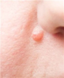 Какими бывают родинки: их типы и виды болезни